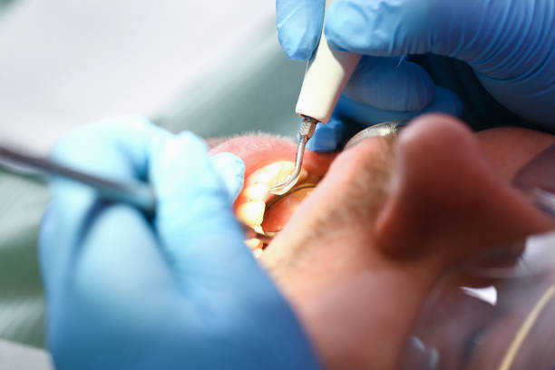 Best Emergency Tooth Extraction in Bliss Corner, MA